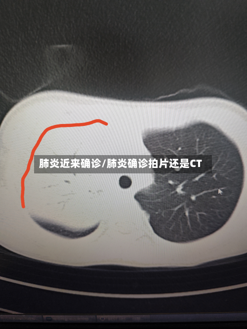 肺炎近来确诊/肺炎确诊拍片还是CT-第2张图片