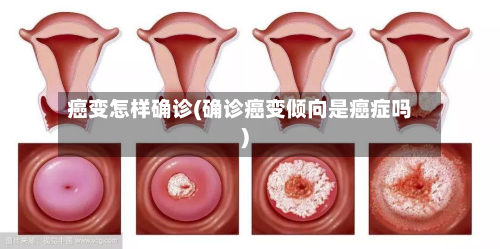 癌变怎样确诊(确诊癌变倾向是癌症吗)-第2张图片