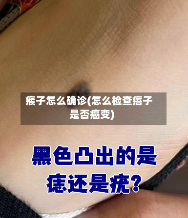 瘊子怎么确诊(怎么检查痦子是否癌变)