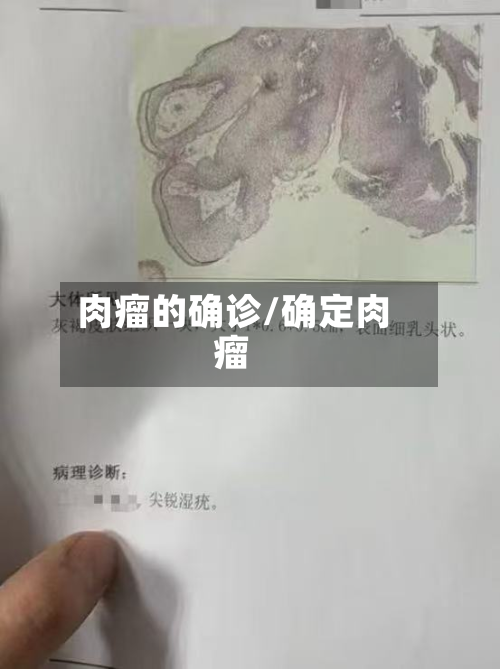 肉瘤的确诊/确定肉瘤