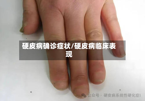 硬皮病确诊症状/硬皮病临床表现-第2张图片