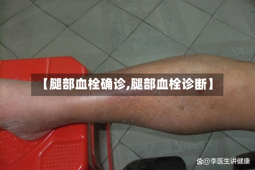 【腿部血栓确诊,腿部血栓诊断】-第2张图片