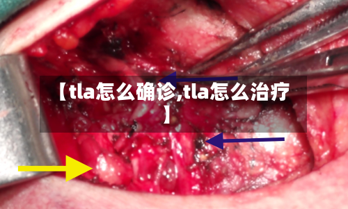 【tla怎么确诊,tla怎么治疗】
