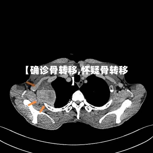 【确诊骨转移,怀疑骨转移】-第2张图片