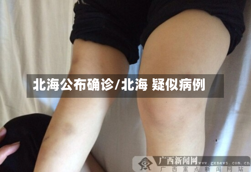 北海公布确诊/北海 疑似病例