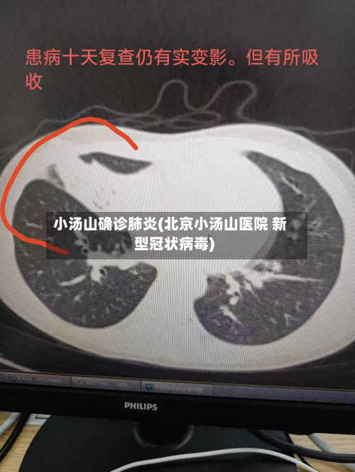 小汤山确诊肺炎(北京小汤山医院 新型冠状病毒)